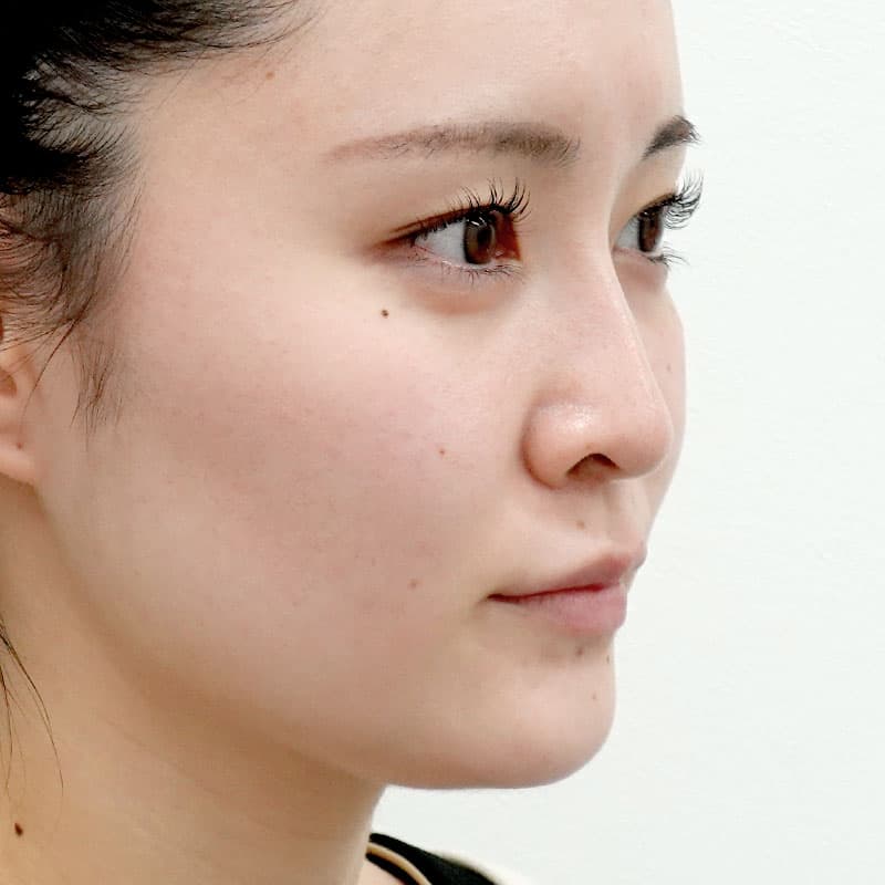20250831_St20250831_tanaka_hyaluronic lips eye bags nose　①After